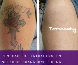 Remoção de tatuagens em Meizhou (Guangdong Sheng)