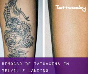 Remoção de tatuagens em Melville Landing