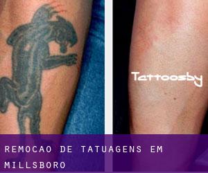 Remoção de tatuagens em Millsboro