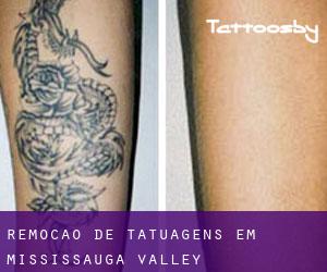Remoção de tatuagens em Mississauga Valley