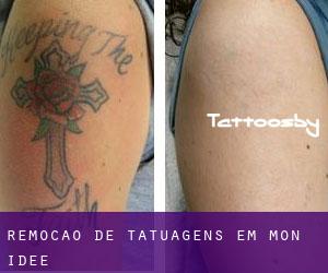 Remoção de tatuagens em Mon Idée