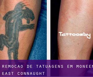 Remoção de tatuagens em Moneen East (Connaught)