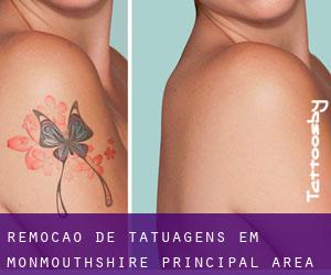Remoção de tatuagens em Monmouthshire principal area