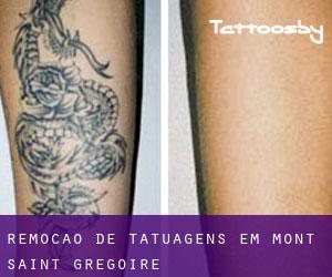 Remoção de tatuagens em Mont-Saint-Grégoire