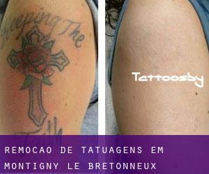 Remoção de tatuagens em Montigny-le-Bretonneux