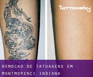 Remoção de tatuagens em Montmorenci (Indiana)