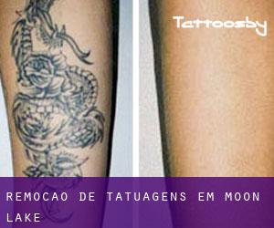 Remoção de tatuagens em Moon Lake