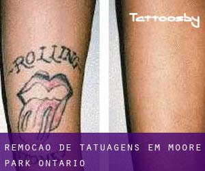Remoção de tatuagens em Moore Park (Ontario)