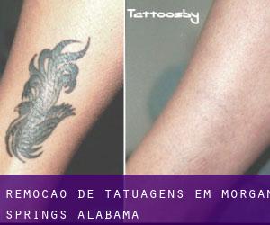 Remoção de tatuagens em Morgan Springs (Alabama)