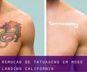 Remoção de tatuagens em Moss Landing (California)
