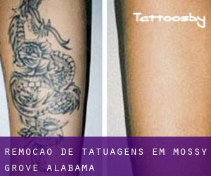 Remoção de tatuagens em Mossy Grove (Alabama)