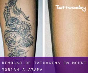 Remoção de tatuagens em Mount Moriah (Alabama)