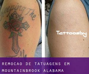 Remoção de tatuagens em Mountainbrook (Alabama)