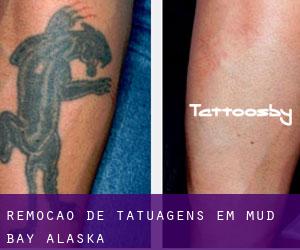 Remoção de tatuagens em Mud Bay (Alaska)