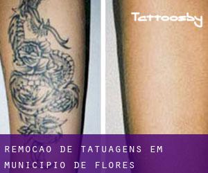 Remoção de tatuagens em Municipio de Flores