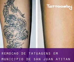 Remoção de tatuagens em Municipio de San Juan Atitán