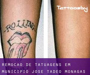 Remoção de tatuagens em Municipio José Tadeo Monagas