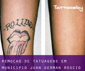 Remoção de tatuagens em Municipio Juan Germán Roscio