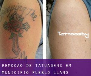 Remoção de tatuagens em Municipio Pueblo Llano