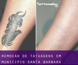 Remoção de tatuagens em Municipio Santa Bárbara