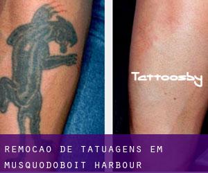 Remoção de tatuagens em Musquodoboit Harbour
