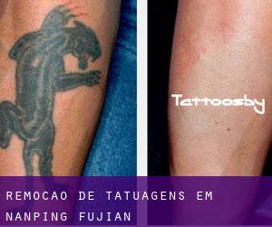 Remoção de tatuagens em Nanping (Fujian)