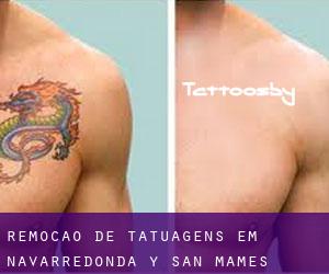 Remoção de tatuagens em Navarredonda y San Mamés