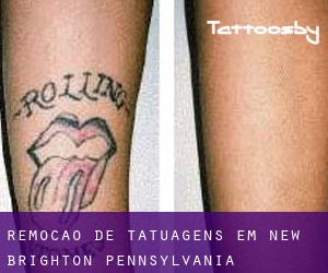 Remoção de tatuagens em New Brighton (Pennsylvania)