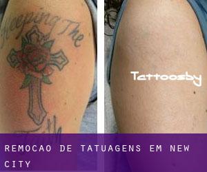 Remoção de tatuagens em New City