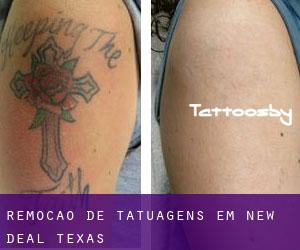 Remoção de tatuagens em New Deal (Texas)
