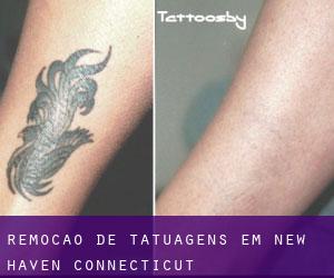 Remoção de tatuagens em New Haven (Connecticut)