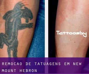Remoção de tatuagens em New Mount Hebron
