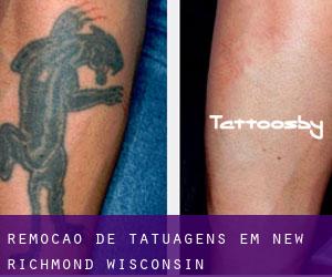 Remoção de tatuagens em New Richmond (Wisconsin)