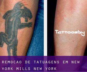 Remoção de tatuagens em New York Mills (New York)