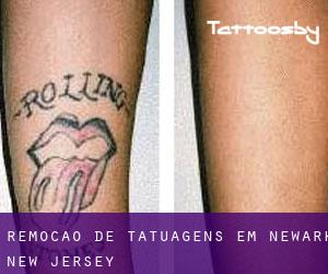 Remoção de tatuagens em Newark (New Jersey)