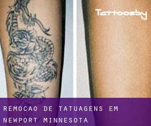 Remoção de tatuagens em Newport (Minnesota)