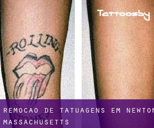 Remoção de tatuagens em Newton (Massachusetts)