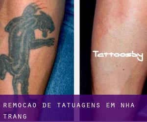 Remoção de tatuagens em Nha Trang