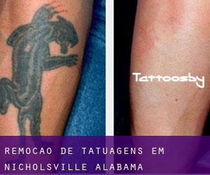 Remoção de tatuagens em Nicholsville (Alabama)