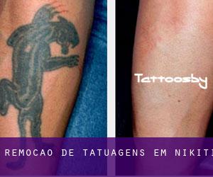 Remoção de tatuagens em Níkiti