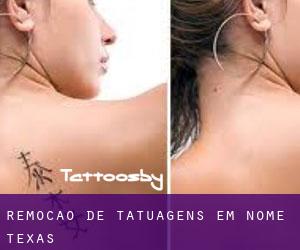 Remoção de tatuagens em Nome (Texas)