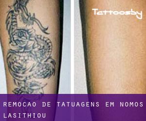 Remoção de tatuagens em Nomós Lasithíou