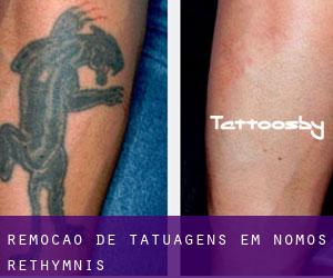Remoção de tatuagens em Nomós Rethýmnis