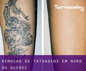 Remoção de tatuagens em Nord-du-Québec