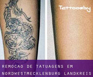 Remoção de tatuagens em Nordwestmecklenburg Landkreis