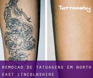 Remoção de tatuagens em North East Lincolnshire