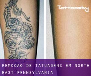 Remoção de tatuagens em North East (Pennsylvania)