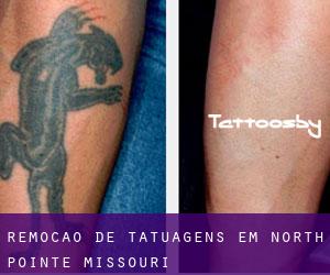 Remoção de tatuagens em North Pointe (Missouri)