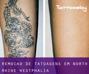 Remoção de tatuagens em North Rhine-Westphalia
