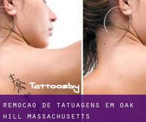 Remoção de tatuagens em Oak Hill (Massachusetts)